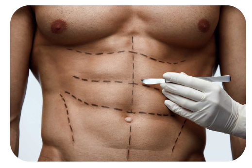 Lipomarcación-medellin