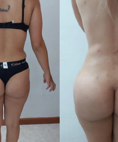 lipotransferencia