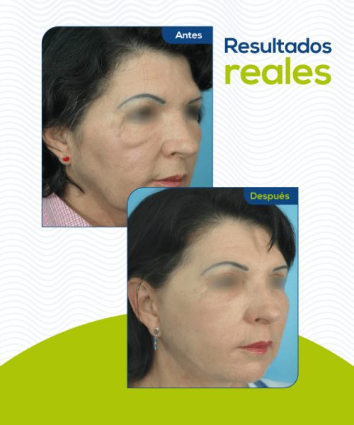Ritidoplastia-Rejuvencimiento-facial-medellin
