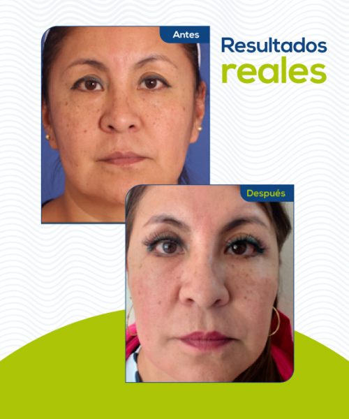 Ritidoplastia-Rejuvencimiento-facial-medellin3