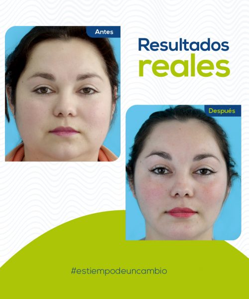 bichectomia-medellin-1