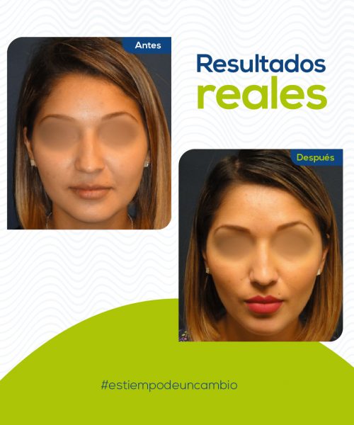 bichectomia-medellin-12