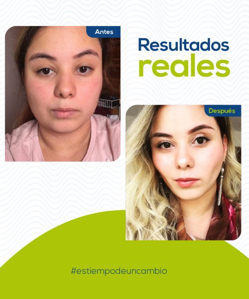 bichectomia-medellin