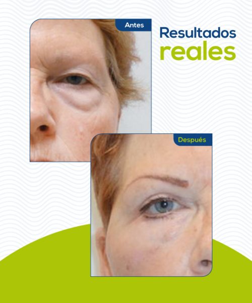 blefaroplastia-medellin2