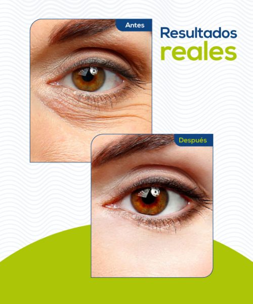 blefaroplastia-medellin3
