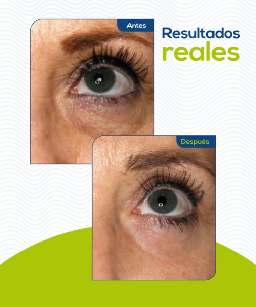 blefaroplastia-medellin4
