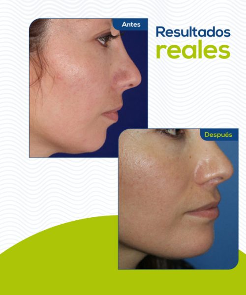 mentoplastia-colombia