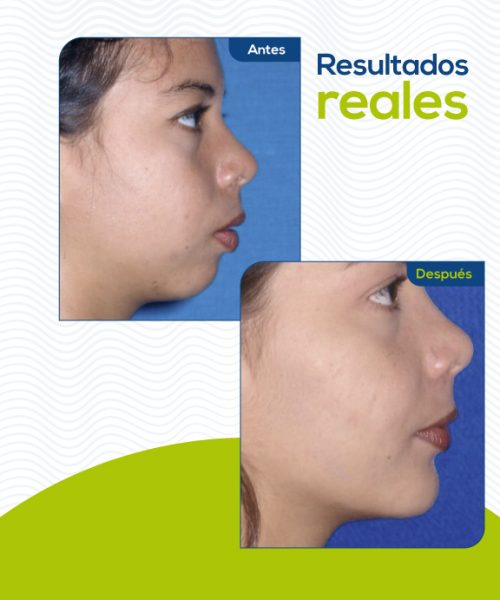 mentoplastia-colombia2