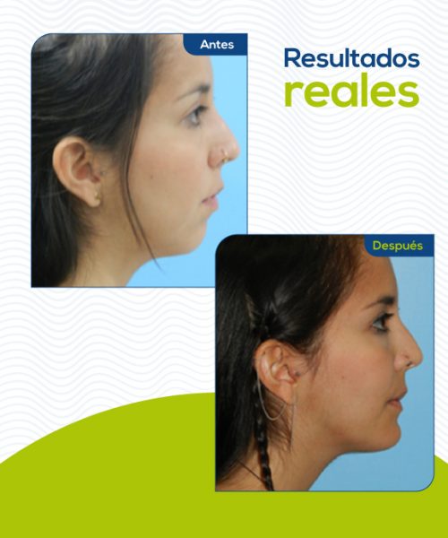 mentoplastia-colombia3